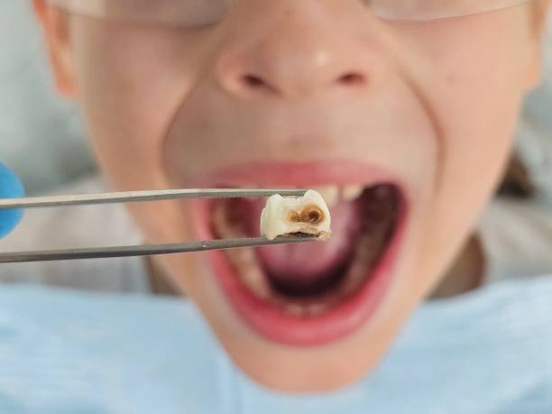 Best Emergency Root Canal Treatment in Lamont, MI